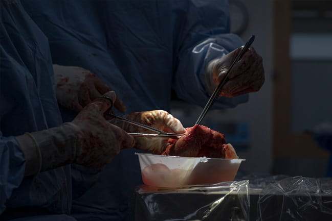 Dr. Katy Morgan removes the pancreas and places it in a dish. 