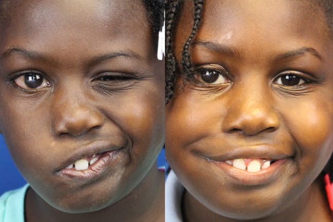 Before and after image of facial paralysis patient