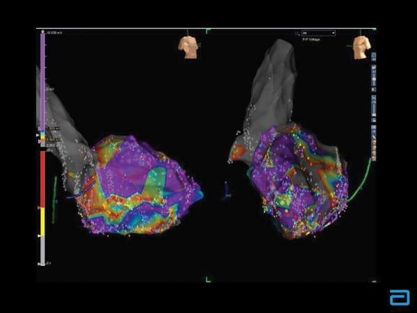 Two Views of a Heart Affected by Cardiac Sarcoidosis